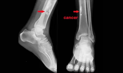 Osteosarcoma Treatment Market