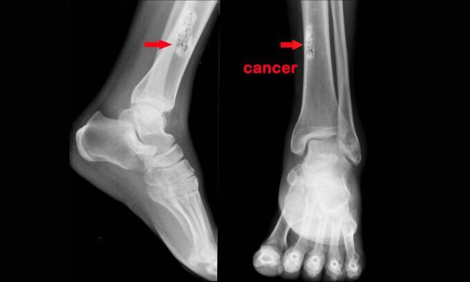 Osteosarcoma Treatment Market