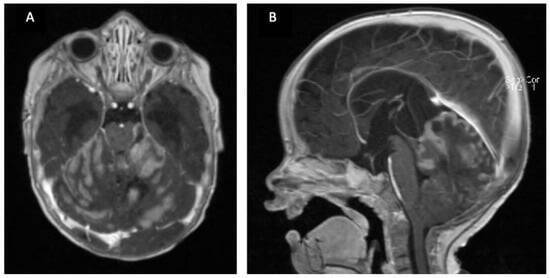 Brain Tumor